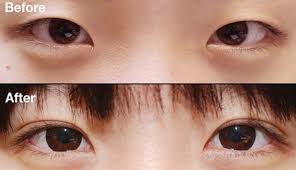 In south korea (hereafter “korea”) in particular, an increasing number of people have been undergoing cosmetic surgery. Top 8 Plastic Surgery Procedures In Korea Quietly