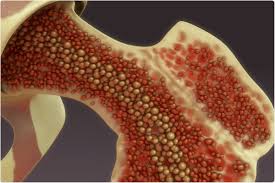 Bone marrow cancer happens when cells in the marrow begin to grow abnormally. Sars Cov 2 Can Alter Bone Marrow Macrophage Bmm To Osteoclast Differentiation Study Finds