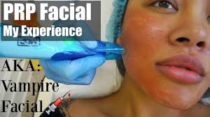 Blood Vampire Facial The Prp Lab Youtube The prp lab is the only clinic in the uk devoted to prp treatments. blood vampire facial the prp lab