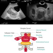 A pelvic ultrasound is a test that uses sound waves to make pictures of the organs inside your pelvis. Female Pelvic Ultrasound Phantom For Gynecology Kyoto Kagaku