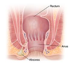 Image result for Perianal Abscess