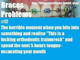 Braces Problems Braces Problems Braces Humor Cute Braces