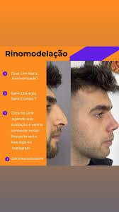 Você quer esse resultado instantâneo? Clica no Link, agende a sua avaliação  e me siga no Instagram!  https://instagram.com/dr.joaopaulocabral?igshid=MzRlODBiNWFlZA==