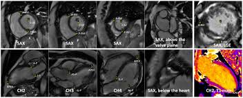 Image result for Cardiac MRI