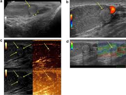 This can show if there is: Adenomatoid Tumor Of The Testis Mimicking Malignant Testicular Cancer On Multiparametric Ultrasound Springerlink