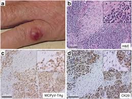 Merkel cell carcinoma, also called neuroendocrine cancer of the skin, is an aggressive type of skin cancer that affects only about 400 people in the united states each year. Clinical And Microscopic Images Of Merkel Cell Carcinoma A Download Scientific Diagram