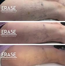 Our company offers the most innovative technology and is at the forefront of the uk laser industry today. Erase Aesthetics Tattoo Removal Middlesbrough Thread Vein Removal Middlesbrough