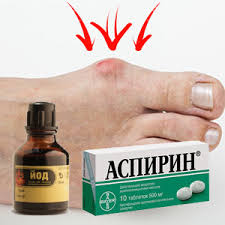 как лечить косточку на ноге в домашних условиях отзывы Lechenie Kostochek Na Nogah Jodom I Aspirinom Otzyvy I Mneniya