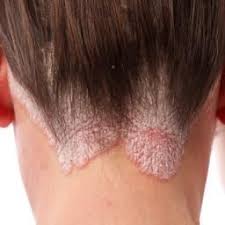 In This Article Learn More About Scalp Psoriasis We Explore Shampoos Home Remedies And Poten Scalp Psoriasis Psoriasis Remedies Home Remedies For Psoriasis