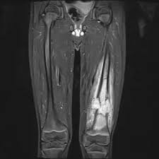 Image result for Osteosarcoma