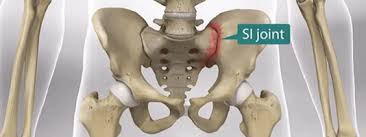 Image result for Sacroiliac Dysfunction