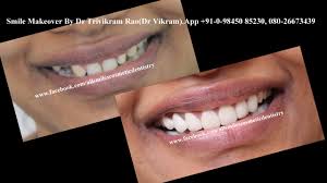 Pin On Best Smile Makeovers In Bangalore