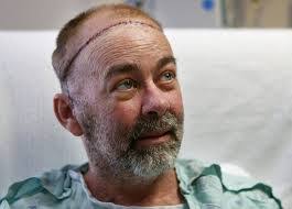 Realizan el primer trasplante de cráneo y cuero cabelludo del mundo en  Estados Unidos