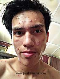 Tak banyak produk kta yang memiliki jangka waktu pinjaman sedemikian lama. Hilangkan Parut Chicken Pox Untuk Orang Dewasa Jejakakaula