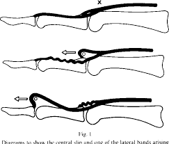 Image result for Elson Extensor Tendon Test