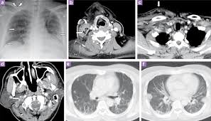 a) Antero-posterior (AP) supine chest radiograph at presentation: a...