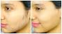 Laser Hair Removal Machine