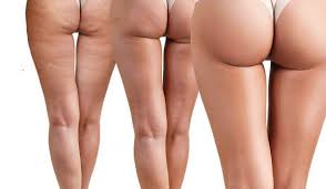 1) the liposuction part, which extracts the amount of fat from unseemly areas. Affordable Bbl How Much Is Bbl In Turkey Hayatmed Turkey