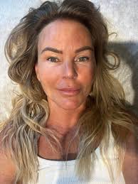 Ta ut gammal fillers ur kroppen