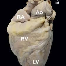 The apex (apex cordis) is directed downward, forward, and to the left, and is overlapped by the left lung and pleura: Heart Standing On Its Apex In The So Called Valentine Position Download Scientific Diagram