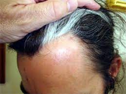 Streak Of White Poliosis Mallen Streak Hair Streaks