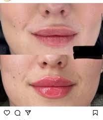 Good evening, I'm looking for recommendations for derma filler, I'm after  my jaw nose and Russian lips before I go away next month, side profile  balancing 🙏 any good recommendations thank you