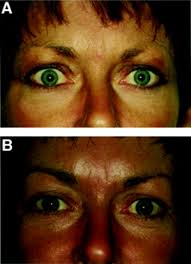 Lid lag on wn network delivers the latest videos and editable pages for news & events, including entertainment, music, sports, science and more, sign up and share your. A Single Technique To Correct Various Degrees Of Upper Lid Retraction In Patients With Graves Orbitopathy British Journal Of Ophthalmology