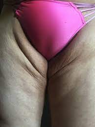 Fat Transfer To Inner Thighs Photos