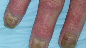 Maybe you would like to learn more about one of these? Psoriatic Arthritis Types Symptoms Diagnosis And More