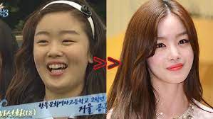 10 Shocking Korean Idol Plastic Surgery Transformations Kpopmap Kpop Plastic Surgery Plastic Surgery Celebrity Surgery