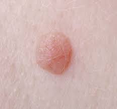 In acest cadru individualizam urmatoarele particularitati. Remediu Pentru ToxiinfecÈ›ia AlimentarÄƒ Pastile Pe BazÄƒ De LigninÄƒ Tratamentul Copiilor Cu Efect Cu Spectru Larg