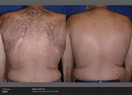 Male brazilian laser hair removal. Laser Hair Removal Treatments For Men Foye Md And Spa