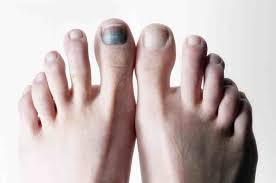 It may be worse at night or when the bone is used, for instance, leg pain when walking. Toe Archives Nedufy