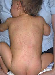 The same occurred with pfizer vaccine side effects, with all three vaccine types also commonly causing varying rates of injection site pain, fever, and muscle soreness. Adverse Reaction To Mmr Immunization Consultant360