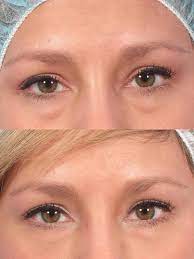 Hereditary Eye Bags - The Science And Theory Of Outsmarting Eyelid Genes -  Dr. Brett Kotlus