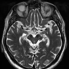 Morning Glory Sign Midbrain Radiology Reference Article Radiopaedia Org