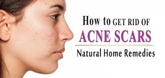 Wondering how to get rid of acne scars? How To Get Rid Of Acne Scars Fast Top 5 Natural Home Remedies Dr Vikram Chauhan S Blog