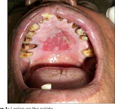 Image result for Fixed Drug Eruption