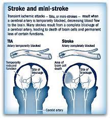 Tia Transient Ischemic Attack Stroke Cva Causes Disorders Braininjury Explanation Com