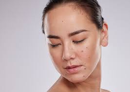 Image result for Skin Tag