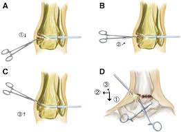 Such a combination of injuries has been reported infrequently in the literature, but significant similarities have been described in the mechanism of injury and fracture patterns. Arthroscopy Assisted Reduction In The Management Of Isolated Medial Malleolar Fracture Arthroscopy