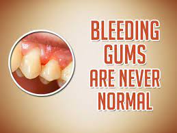If Your Gums Bleed When You Brush It Could Be A Sign Of Gingivitis The Early Stage Of Gum Disease For All Your Dental Needs Click On Dental Gum Bleeding Gum