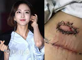 배우에게 치명적인 흉터가 남을 수 있다는 우려에 대한 안타까운 시선과 더불어 한예슬이 아니면 그나마도 묻혔을 의료사고 아니냐는 비판적 시각이 우세하다. í•œì˜ˆìŠ¬ ì˜ë£Œì‚¬ê³  ë³´ìƒ ë'ê³  ì„¤ì „ ì—°ì˜ˆì¸ì˜ íŠ¹ê¶Œ Vs ì§'ë„ì˜ ì–'ì‹¬ ê³ ë°± ì´íˆ¬ë°ì´