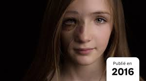 Des Edmontoniens dévoilent leur beauté sous leurs cicatrices