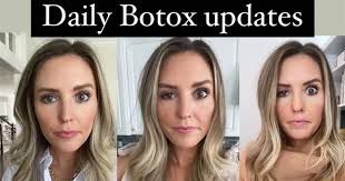 You should notice some weakness in the muscle at that point, although a decrease in muscle size can take several treatments spaced 3 months apart. One Blogger S Experience With A Rare Botox Side Effect