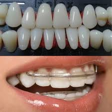 Pastikan tak pakai fake braces ya.hehe harini, jasmin nak tunjuk penjagaan gigi braces.tak mudah tau. Pakai Retainer Dan Gigi Palsu