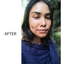 Overcoming acne-prone skin with proper skincare routine and product  recommendations