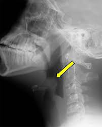 Image result for Epiglottitis