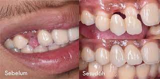 Geraham bungsu adalah jenis gigi struktur gigi anda mungkin mengalami perubahan setelah operasi cabut gigi geraham bungsu. Crown Gigi Harga Promo 2021 Hanya 1 699 Juta Dapatkan Di Kota Kamu