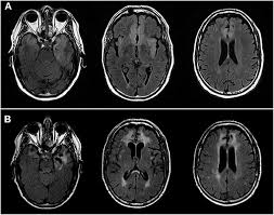 Serology for hsv showed positive hsv (1+2) igg and negative igm. Frontiers Two Cases Of Late Onset Anti Nmdar Auto Immune Encephalitis After Herpes Simplex Virus 1 Encephalitis Neurology